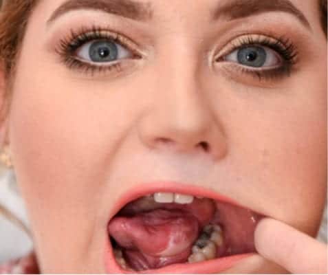 मुँह का कैंसर लक्षण और उपचार – Oral cancer symptoms in hindi