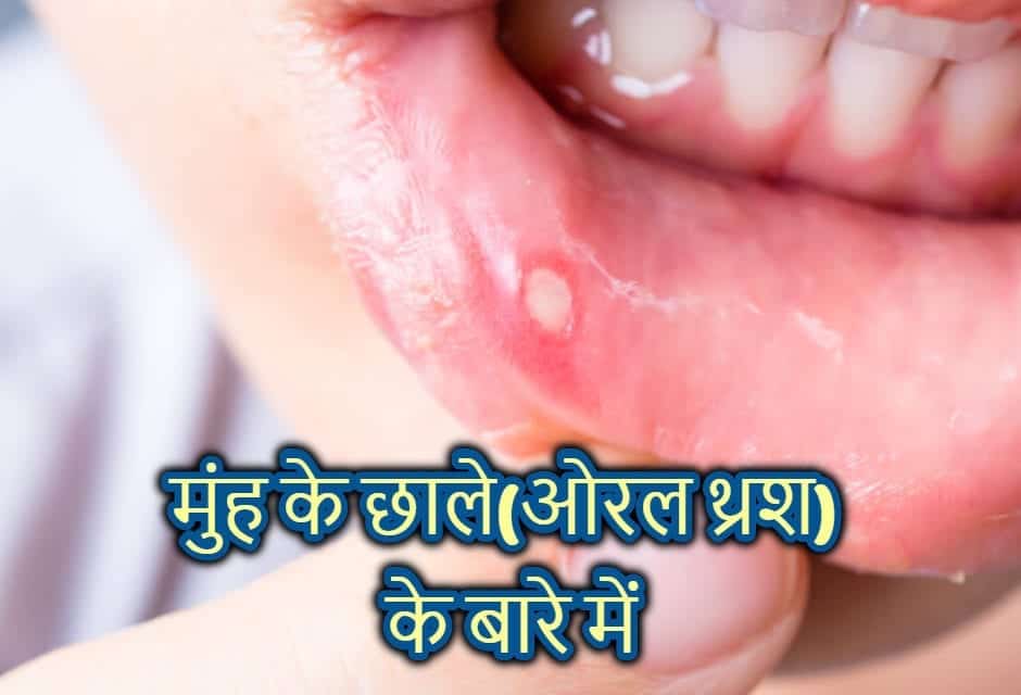 oral thrush in hindi – मुंह के छाले के बारे में