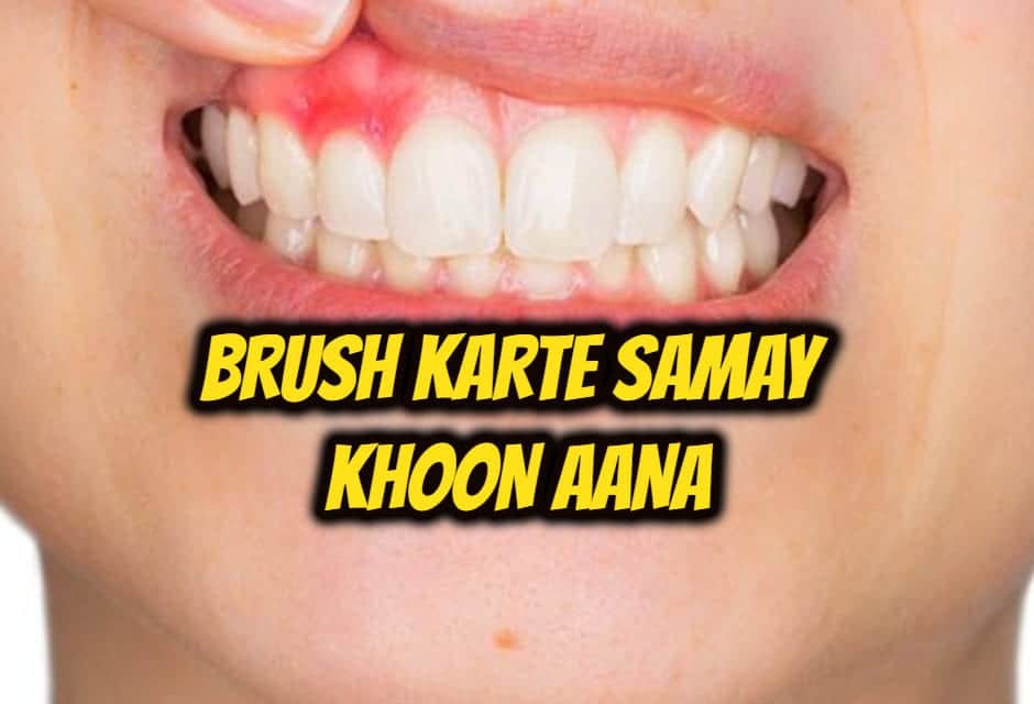 ब्रश करते समय खून आना – bleeding gums in hindi