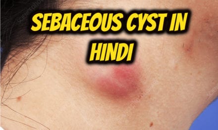 सिबेसियस सिस्ट के बारे में – sebaceous cyst in hindi
