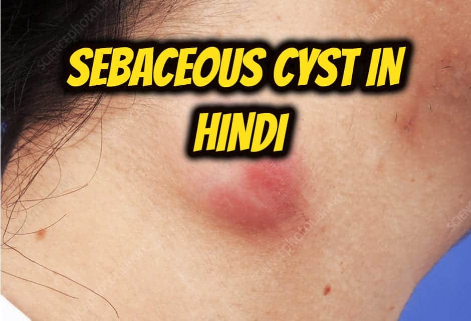 सिबेसियस सिस्ट के बारे में – sebaceous cyst in hindi