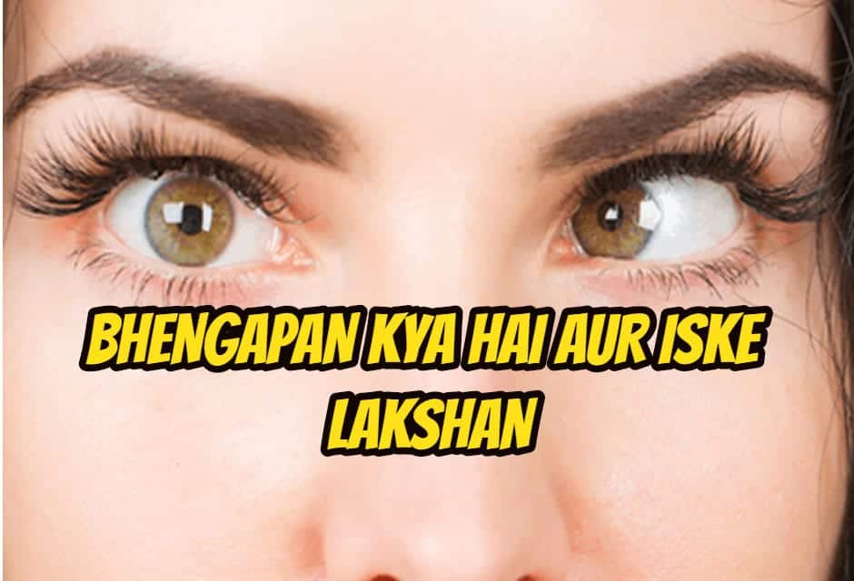भेंगापन के बारे में – squint eyes in hindi
