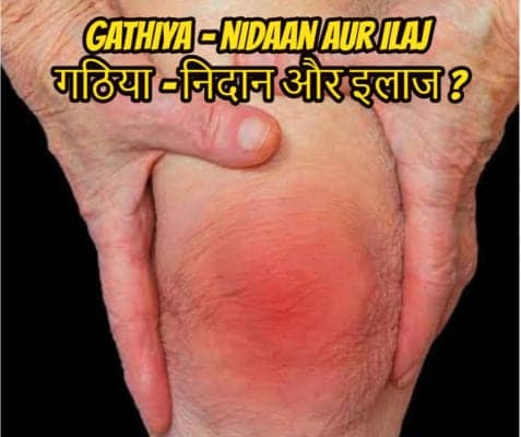 गठिया से बचाव – arthritis prevention in hindi