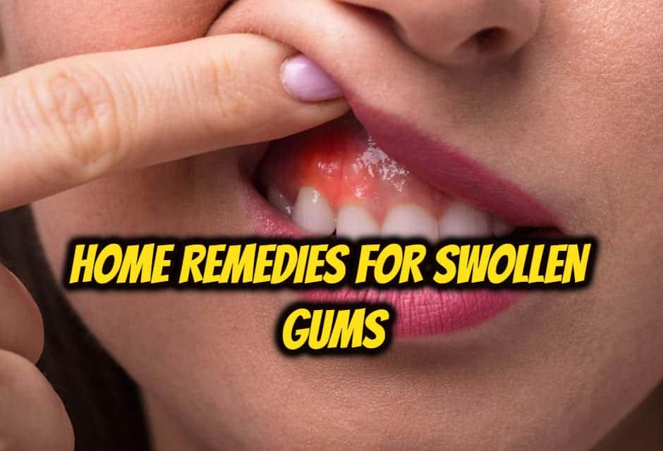 मसूड़ों की सूजन का घरेलू इलाज – Home remedies for Swollen Gums in hindi