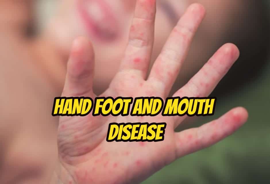 बच्चों को हैंड, फुट एंड माउथ डिजीज – Hand Foot and Mouth Disease in hindi
