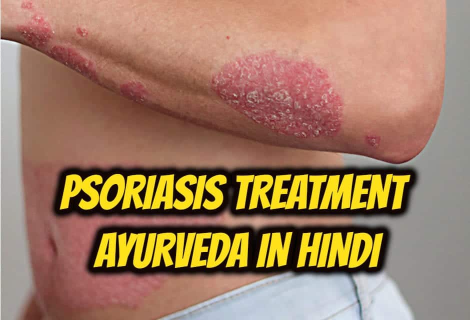 सोरायसिस का आयुर्वेदिक इलाज – Psoriasis Treatment Ayurveda in hindi