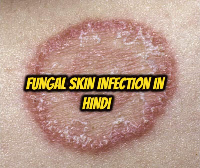 Fungal Skin Infection In Hindi - फंगल स्किन इंफेक्शन