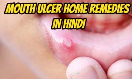 माउथ अल्सर के कारण और इलाज – Mouth Ulcer home remedies in hindi