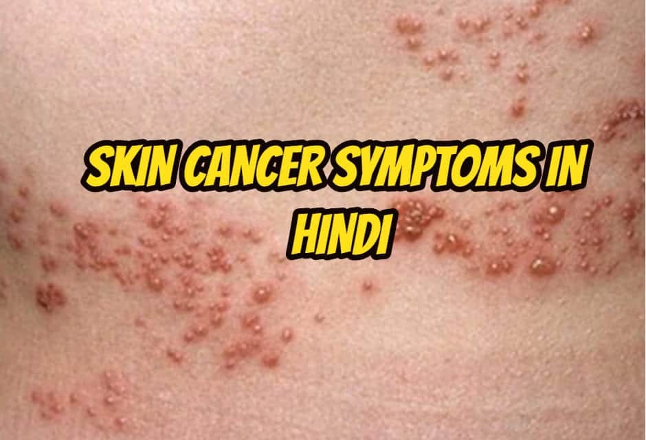 स्किन कैंसर के लक्षण – Skin cancer symptoms in hindi