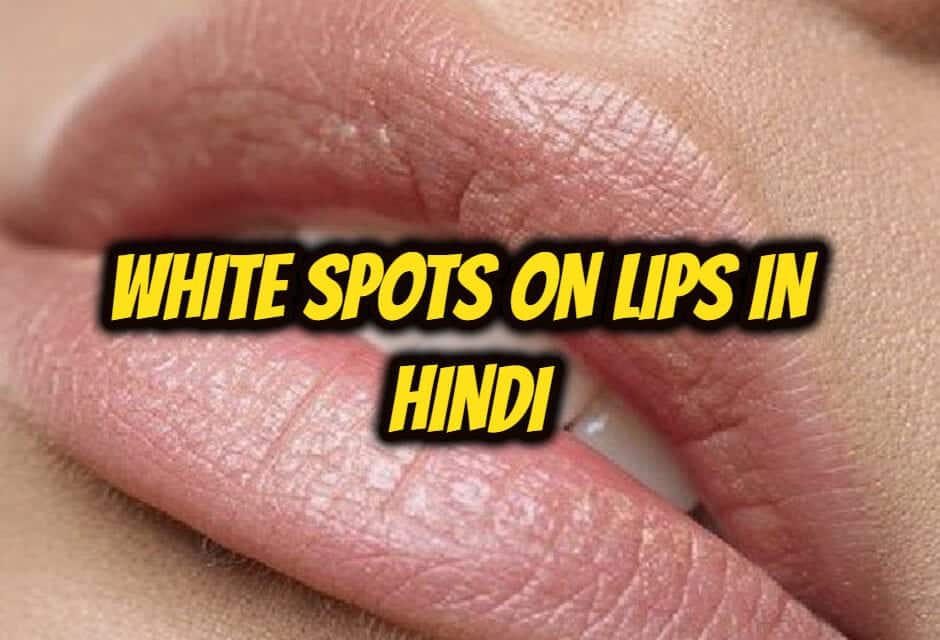 होठों पर सफेद स्पॉट – white spots on lips in hindi