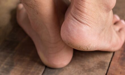 पैरों से डेड स्किन को कैसे हटाएं – How to remove dead skin from feet