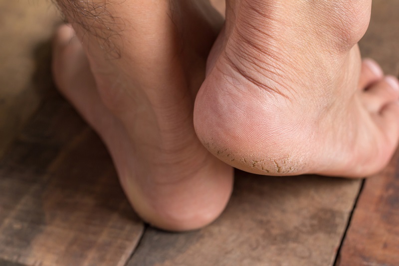 पैरों से डेड स्किन को कैसे हटाएं – How to remove dead skin from feet