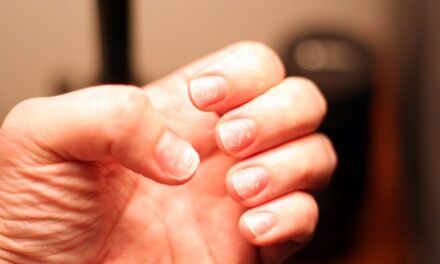 नाखूनों पर सफेद स्पॉट के कारण, लक्षण, निदान, इलाज – White Spots on Nails