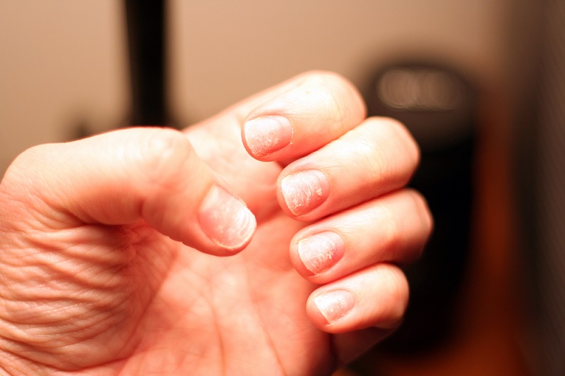 नाखूनों पर सफेद स्पॉट के कारण, लक्षण, निदान, इलाज – White Spots on Nails