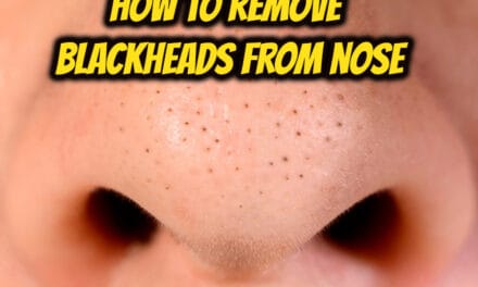 नाक से ब्लैकहेड कैसे हटाएं – How to remove Blackheads from Nose