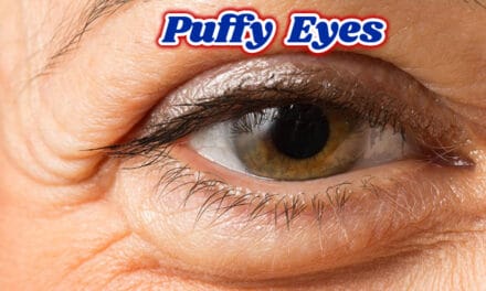 आंखों की सूजन से छुटकारा पाएं – Puffy Eyes