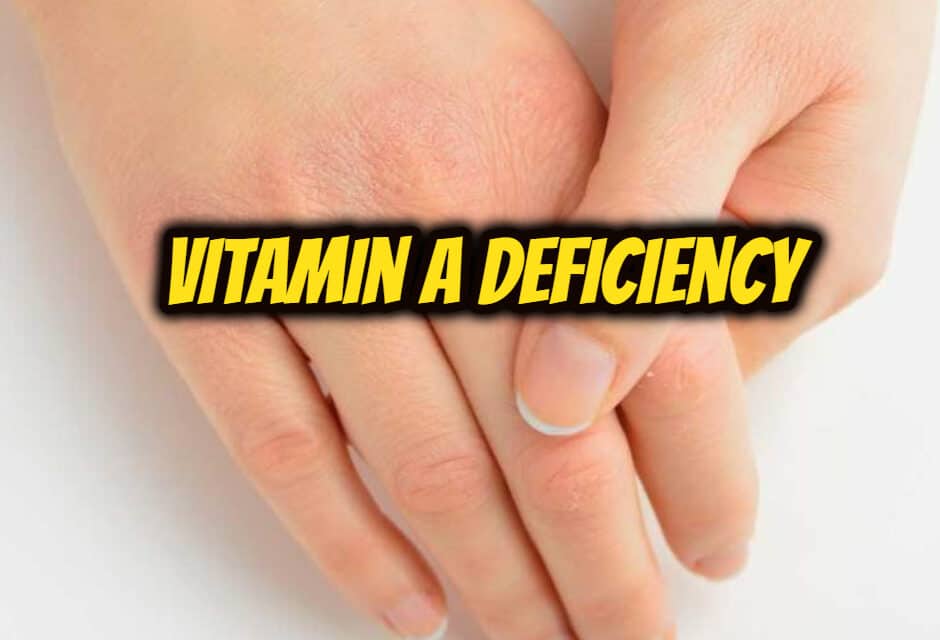 विटामिन ए की कमी के बारे में – Vitamin A Deficiency