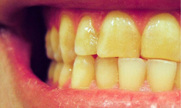 How to get rid of Yellow Teeth