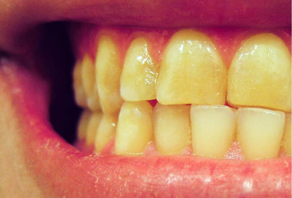 पीले दांतों से छूटकारा पाएं – How to get rid of Yellow Teeth