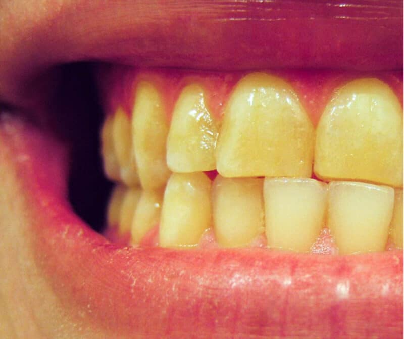 How To Get Rid Yellow Teeth