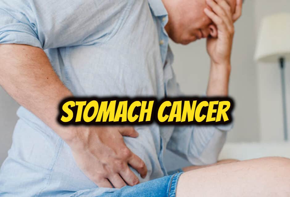 पेट का कैंसर – Stomach Cancer