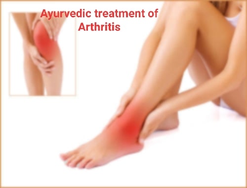 गठिया का आयुर्वेदिक इलाज – Ayurvedic Treatment for Arthritis