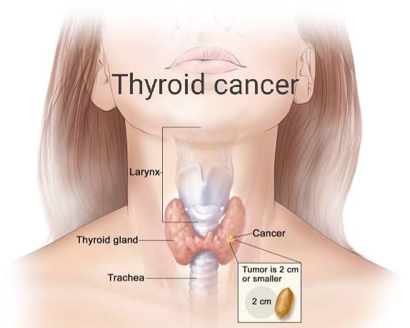 थायराइड कैंसर – Thyroid Cancer
