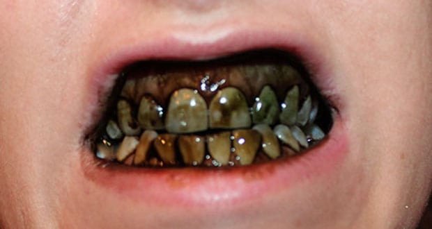 काले दांत के कारण, लक्षण, इलाज – Black Teeth