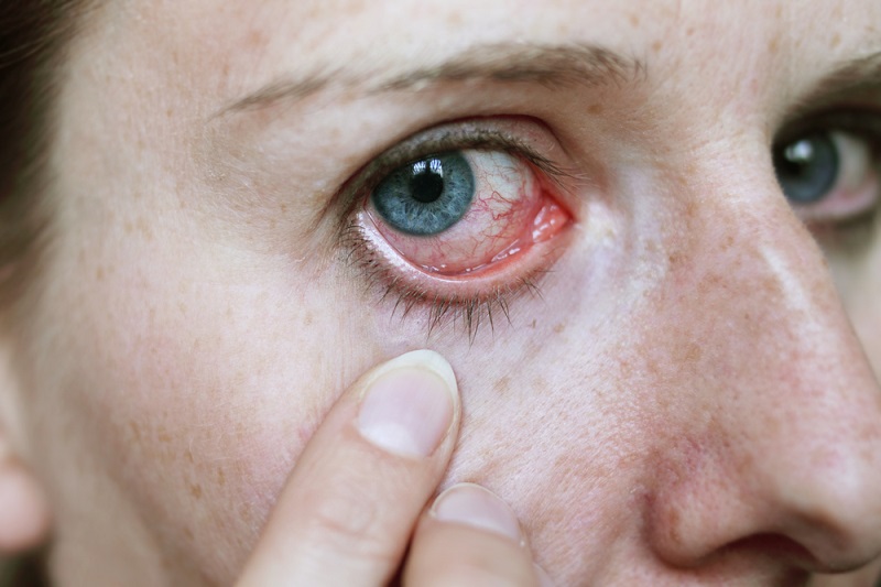 आंखों के सूखापन (ड्राइनेस) का घरेलू उपचार – Dry eyes home remedies