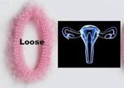 योनि का ढीलपान – loose vagina