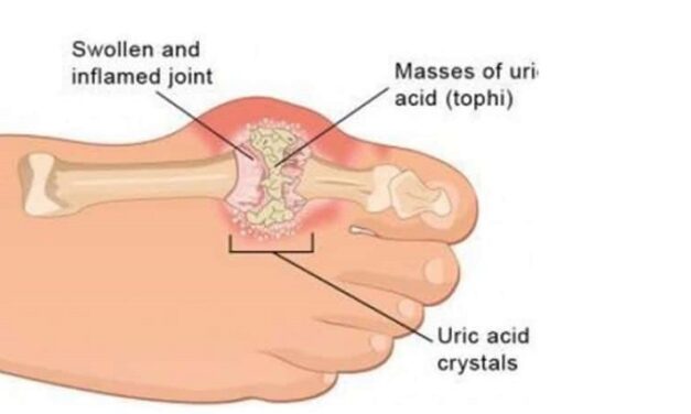 यूरिक एसिड आयुर्वेदिक इलाज – Uric Acid Treatment in Ayurveda
