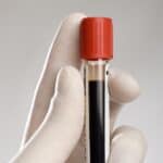 Top 6 Blood Tests Used to Diagnose Rheumatoid Arthritis