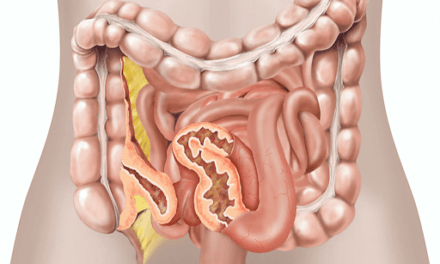 क्रोहन रोग – Crohn’s Disease
