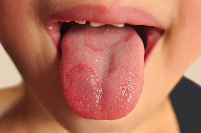जीभ पर छाले के उपाय – Sore Tongue Remedies