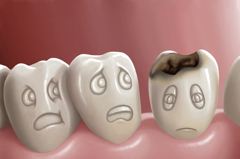 कैविटी से छुटकारा कैसे पाएं – How to Get Rid of Cavities at home